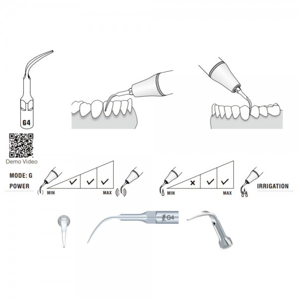 G4 Woodpecker Scaler Tip, Treatment of Interproximal Spaces and Supragingival Scaling