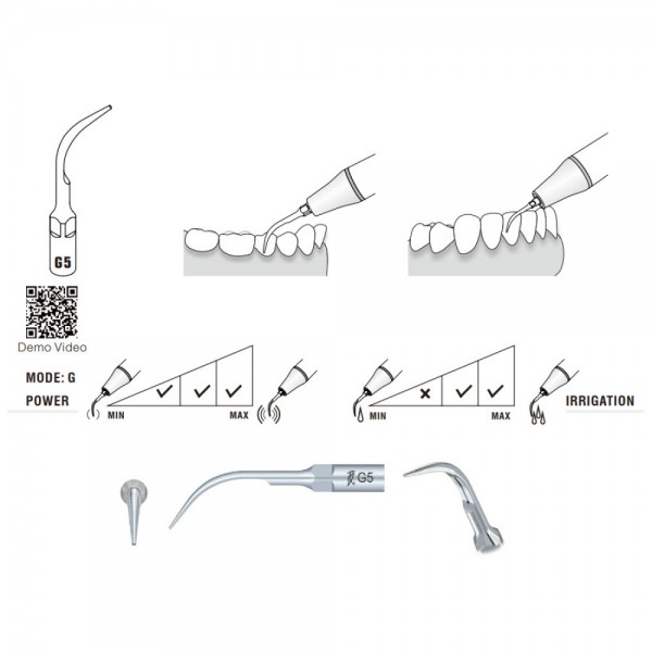 G5 Woodpecker Scaler Tip, Treating Simple Cases and Gross Supragingival Scaling